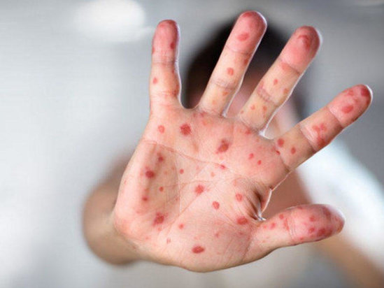 Səhiyyə Nazirliyindən qızılca xəstəliyi ilə bağlı mühüm AÇIQLAMA