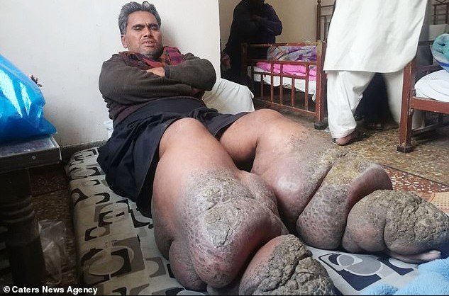 Ağcaqanad sancdı, ayaqları tutuldu – Foto (18+)