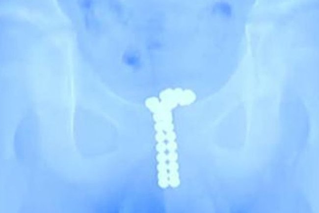 12 yaşlı uşağın cinsiyyət orqanından çıxanlar həkimləri şoka saldı - FOTOLAR