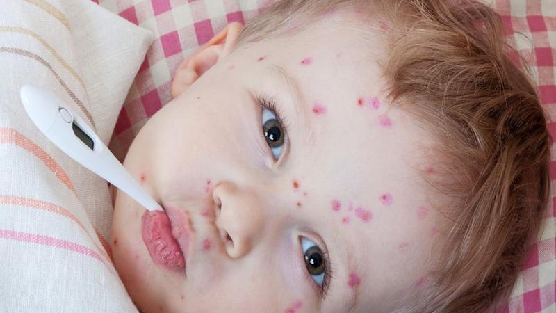 Daha bir ölkədə qızılca epidemiyası