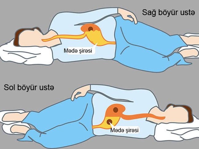 Nə üçün sol böyür üstə yatmaq lazımdır?