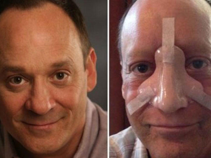 Serial ulduzu burun xərçəngindən öldü