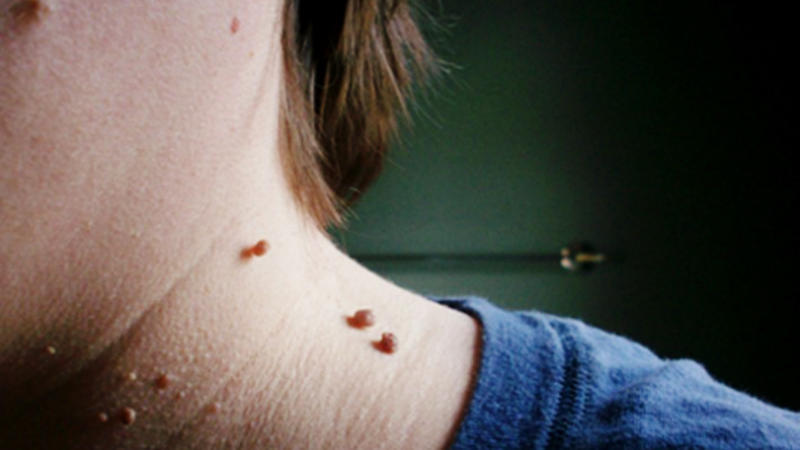 Ət xalllardan qurtulmağın ən təbii üsulu