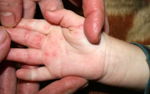 Bakıda suçiçəyinə bənzər virus yayılıb