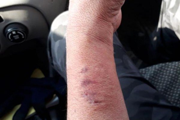 Millət vəkili polisin əlini dişlədi - FOTO (VİDEO)