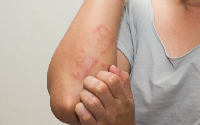 Şəhərdə yaşayanların allergiyadan daha çox əziyyət çəkməsinin səbəbləri