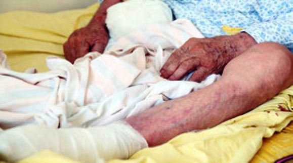 Ayağı amputasiya olunan xalq artistinin digər ayağı da kəsiləcək? - HƏKİMİ DANIŞDI