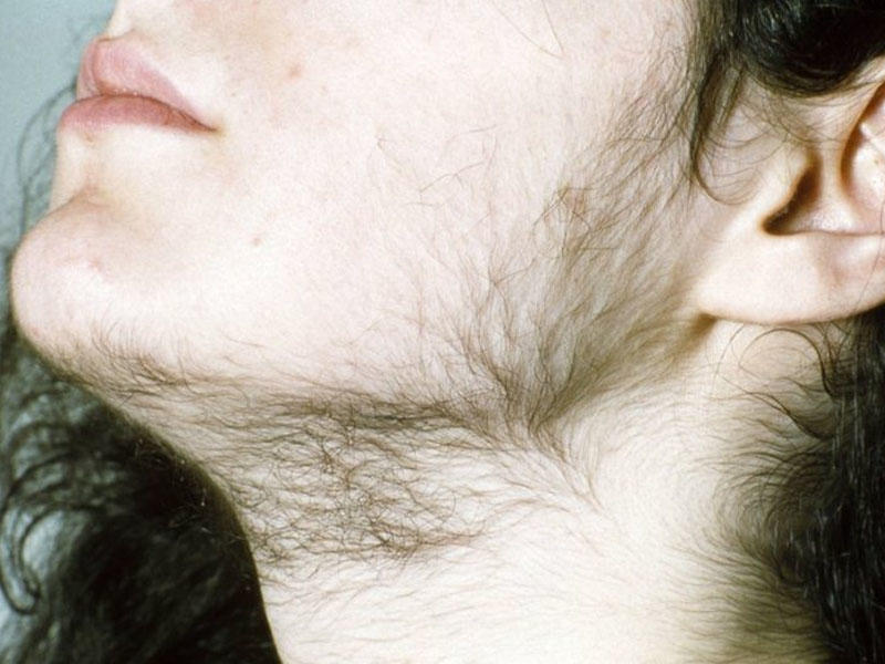 Çənədəki tüklərdən qurtula bilmirsinizsə... - Səbəblərini öyrənin, xəstəlik əlamətidir...