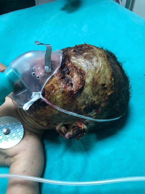 Üzünə benzin töküb yandırılan uşaqla bağlı daha bir dəhşətli xəbər: Anası körpəni satmaq istəyirmiş