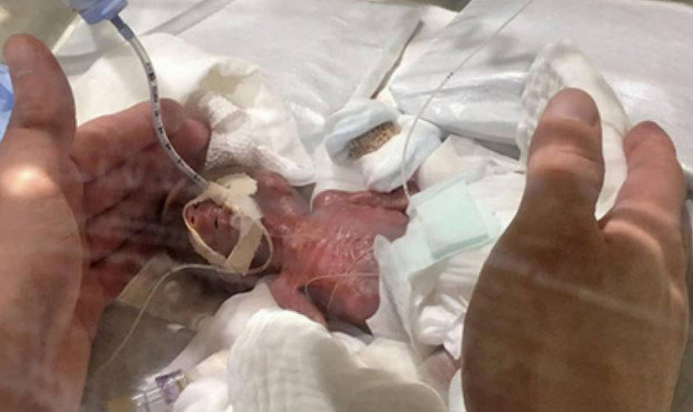 Dünyanın ən balaca körpəsi Yaponiyada doğuldu – Foto