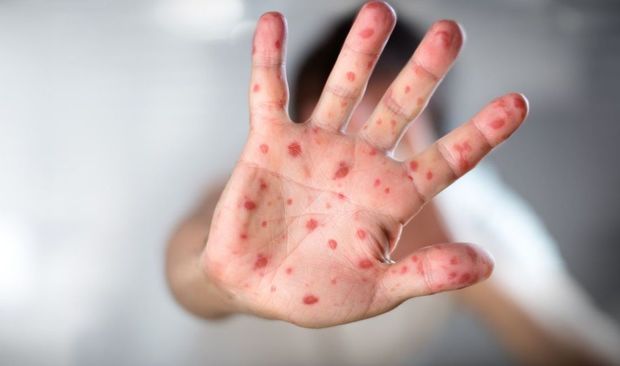 Səhiyyə nazirindən qızılca xəstəliyi ilə bağlı - ƏMR