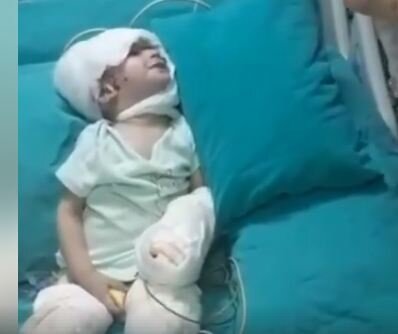 Bakıda üzü benzinlə yandırılan 2 yaşlı uşağın son vəziyyəti necədir? - Xəstəxanadan VİDEOSU YAYILDI