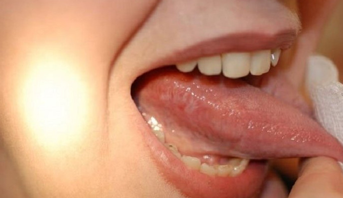 Dil xərçənginin 5 əlaməti