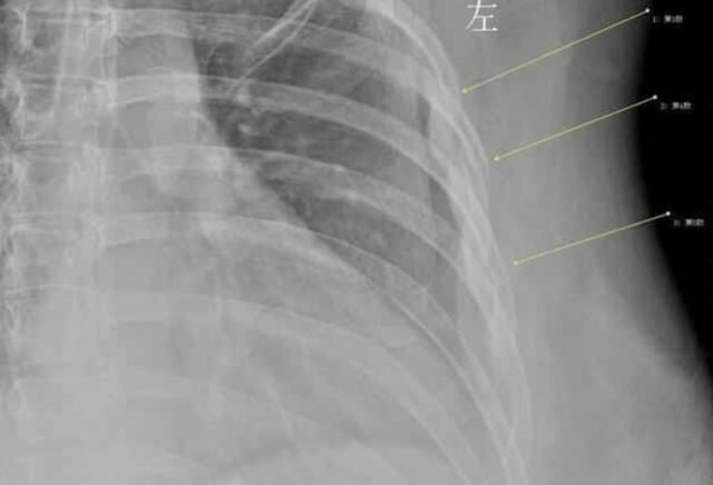 Gündə 10 stəkan içdi - başına bu hadisə gəldi/ İDDİA- FOTO