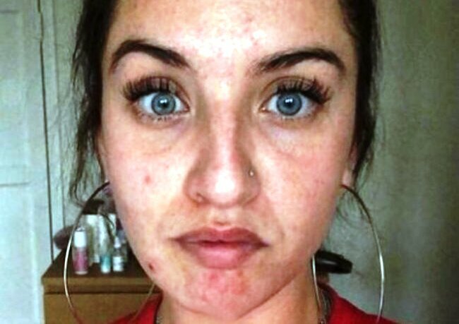Üzündə ləkələr yaranan 29 yaşlı qadın həkimə getdi, eşitdiklərindən şoka düşdü - FOTOLAR