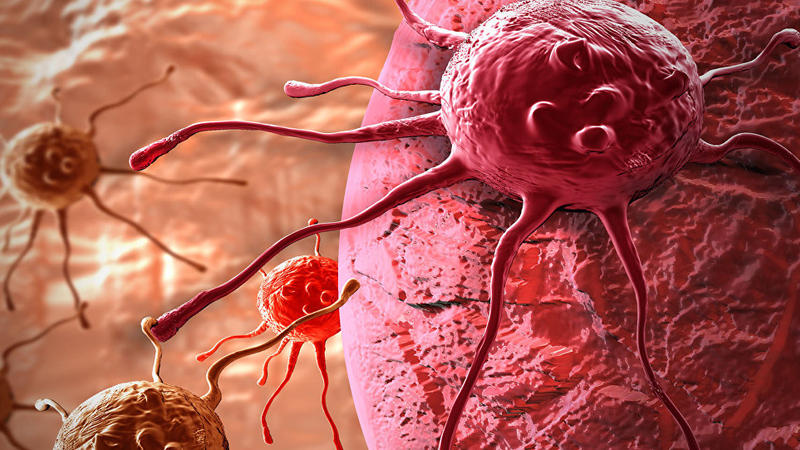 Xərçəngin bir nömrəli səbəbləri açıqlandı: 2 il öncə xəbər tutsanız...