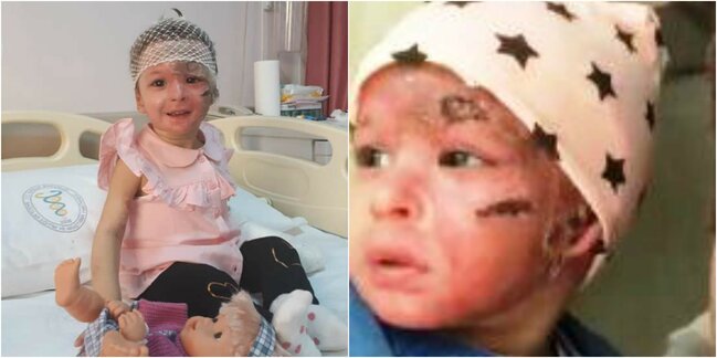 Bakıda üzünə benzin tökülən uşaq 8 əməliyyatdan sonra bu haldadır - SON VİDEO