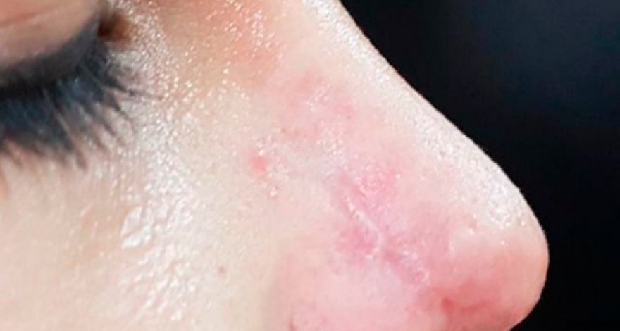 Azərbaycanda dəhşət: kosmetoloq qızın burnunu çürütdü - FOTO