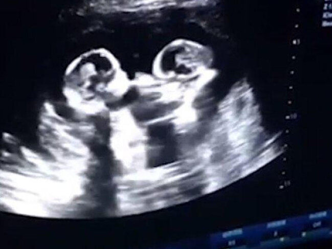 Ana bətnindəki əkizlərin bir-birinə etdiyi bu hərəkət hamını ŞOKA SALDI - İNANILMAZ - VİDEO