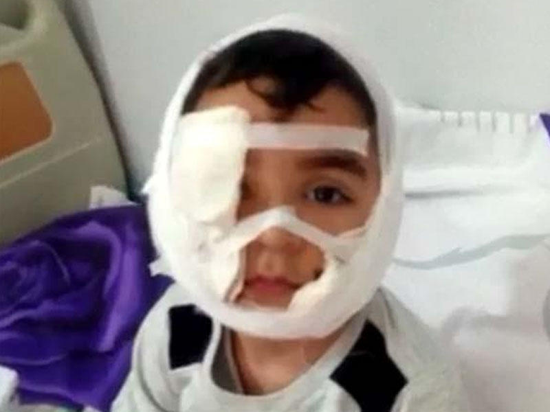 Üzünü it parçalayan uşağın atası: Oğlumun üzünü əməliyyat etdilər, lakin...