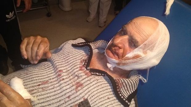 Lənkəranda bir gecədə 9 nəfəri it dişləyib - FOTO