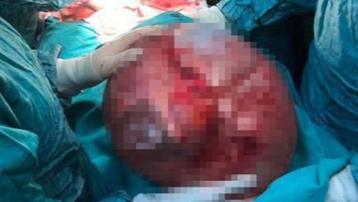 Qarın ağrısı ilə həkimə getdi - Düz 46 kiloluq şiş.../FOTOLAR