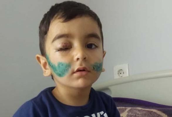 Üzünü it parçalayan Hüseynin son vəziyyəti - FOTO