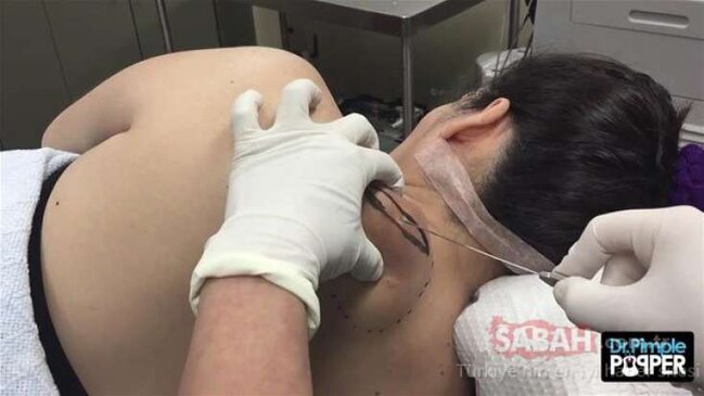 Şok edən görüntü! Qadının kürəyindən görün nə çıxdı... - fotolar