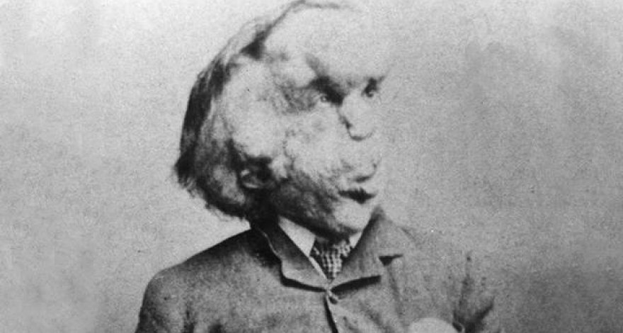 В Лондоне обнаружили затерянную могилу Человека-слона