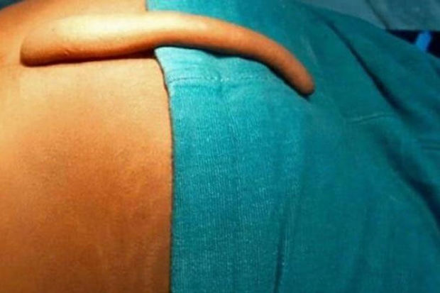 Azərbaycanda 17 yaşlı oğlanda quyruq aşkarlanıb - FOTO