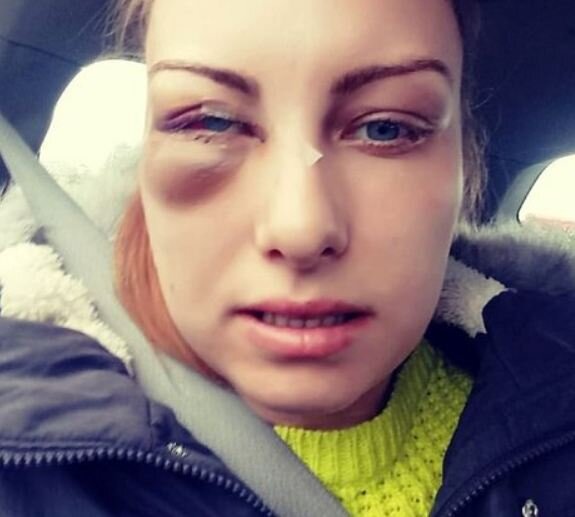 Gənc qız sevgilisi tərəfindən vəhşicəsinə döyüldü: KOR QALA BİLƏR - FOTOLAR