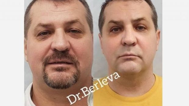 Rusiyada dələduz tutulmamaq üçün üzünü əməliyyat etdirdi – VİDEO
