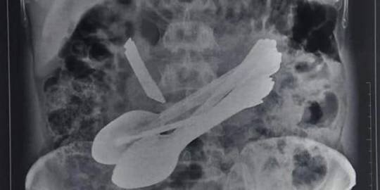 Belə şey nə görüldü, nə də eşidildi - Mədəsindən elə şeylər çıxdı ki,...