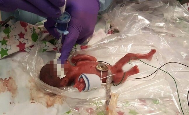 Dünyanın ən kiçik körpəsi - 245 qram doğuldu + Fotolar