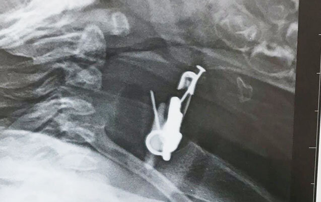 Gözdəyməmək üçün vurmuşdular, körpə uddu - Azərbaycanda+Foto