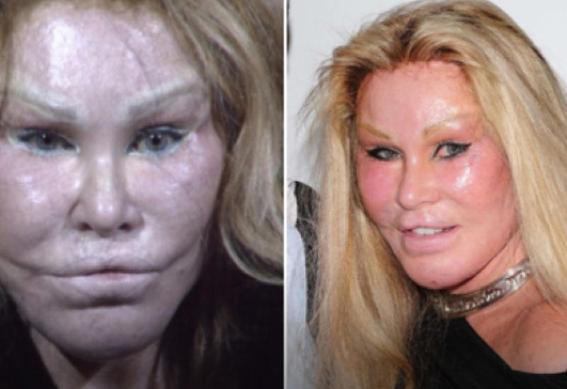 Самая известная жертва пластической хирургии вышла замуж в 71 год - 7 ФОТО