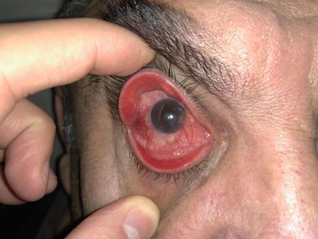 Gədəbəy sakininin gözünə bıçaq soxdular