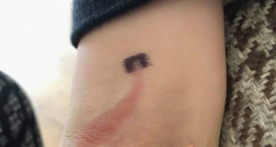 Мать заметила ссадину на руке сына и спасла ему жизнь