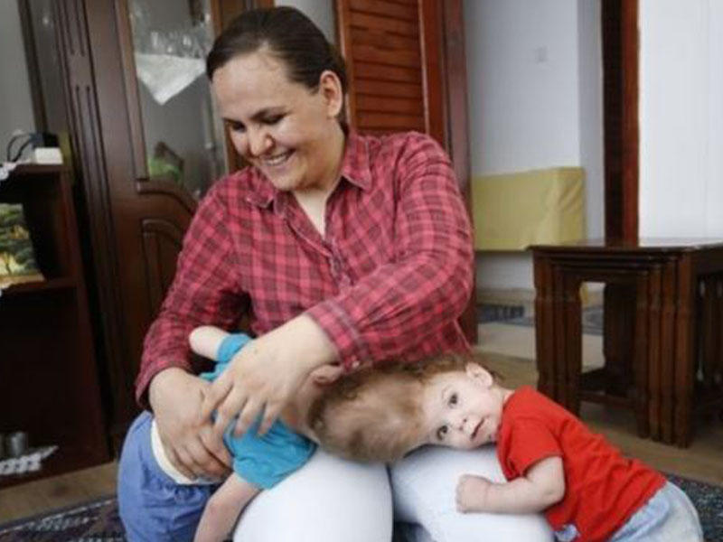 Türkiyənin siyam əkizləri: 