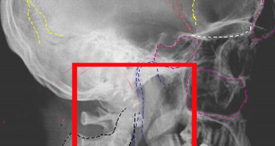 Жительница Петербурга проломила череп мужу во время скандала