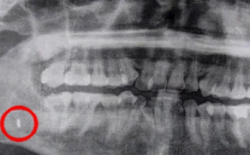 Həkimlər qızın ağzından 5 il əvvəl unudulmuş əşyanı çıxartdılar