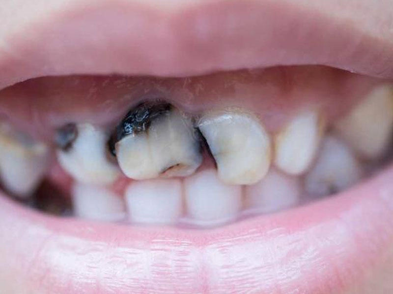 Bu qidalar dişləri MƏHV EDİR - Məşhur stomatoloqdan VACİB XƏBƏRDARLIQ