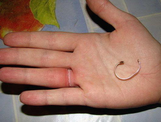 Спасатели в Баку помогли снять железное кольцо с пальца