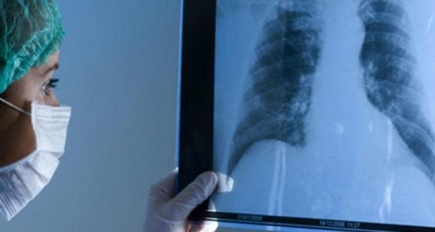 Стало известно, сколько людей в Азербайджане заразились туберкулезом в I полугодии