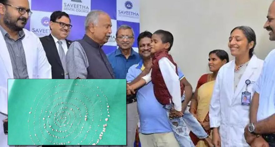 В Индии ребенку удалили 526 зубов