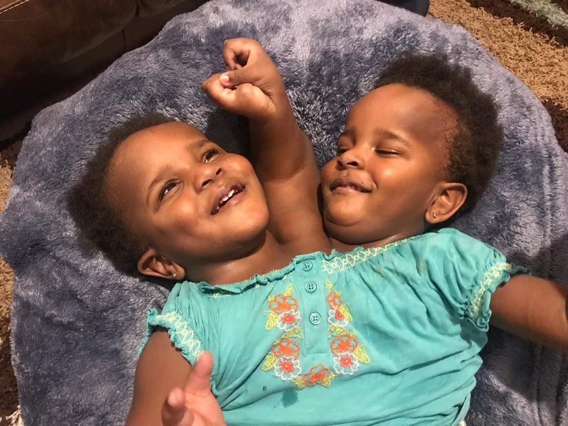 Eyni bədəndə iki ayrı həyat - Fotolar