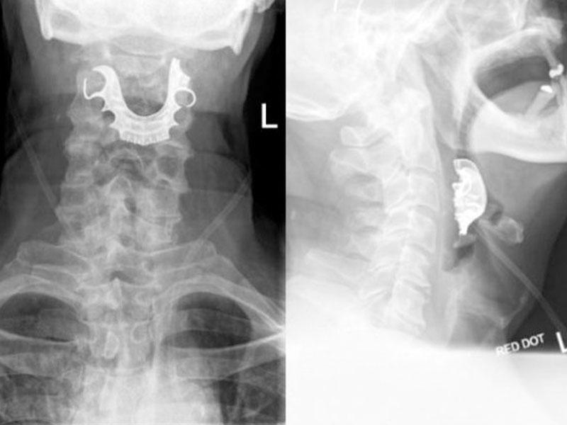 Əməliyyat zamanı protez dişləri boğazına düşdü