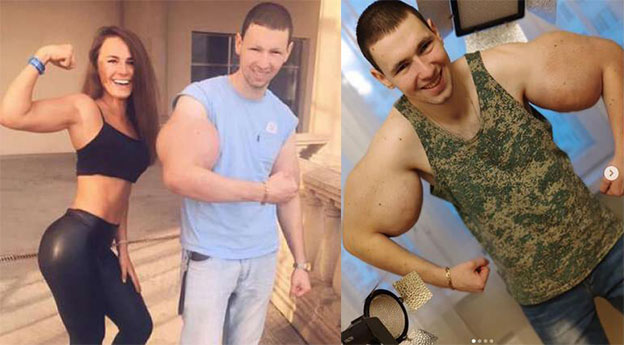 Əzələlərini iynə ilə şişirdənin qolları kəsilə bilər – Foto