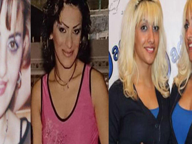 Estetik əməliyyatlarla dəyişən məşhurlarımız - FOTO