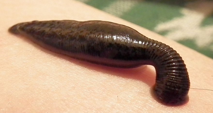 Мальчик с пиявкой в горле десять дней кашлял кровью и выжил